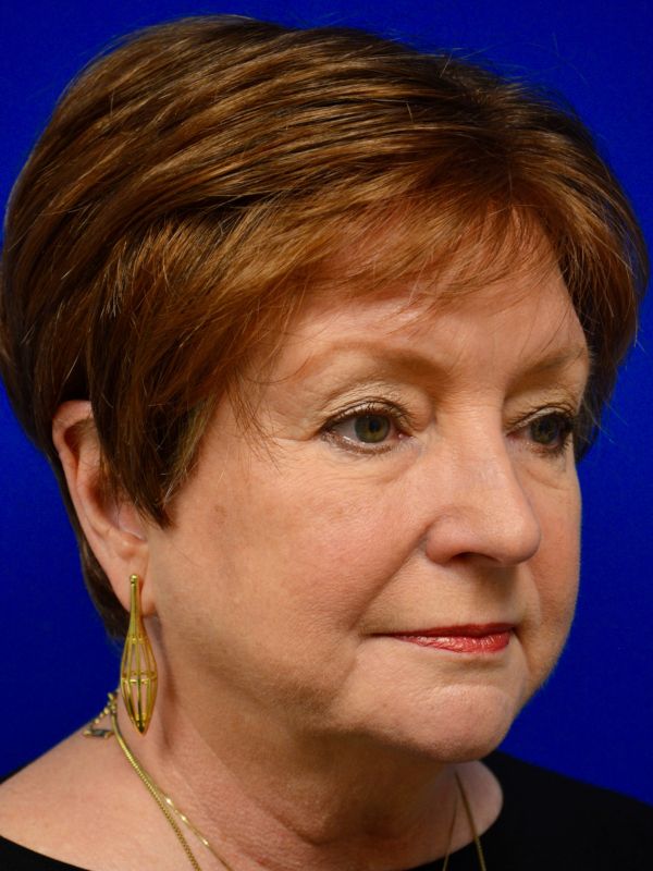 Facelift Before & After Image