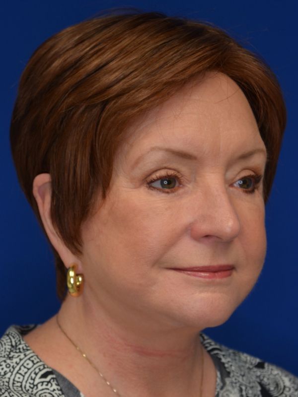Facelift Before & After Image