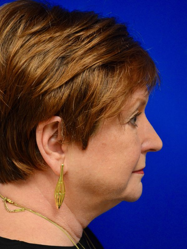 Facelift Before & After Image