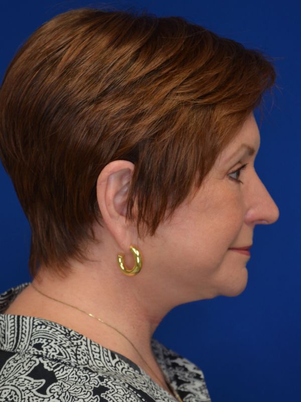 Facelift Before & After Image