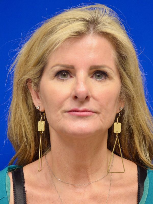 Facelift Before & After Image