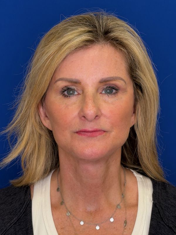 Facelift Before & After Image