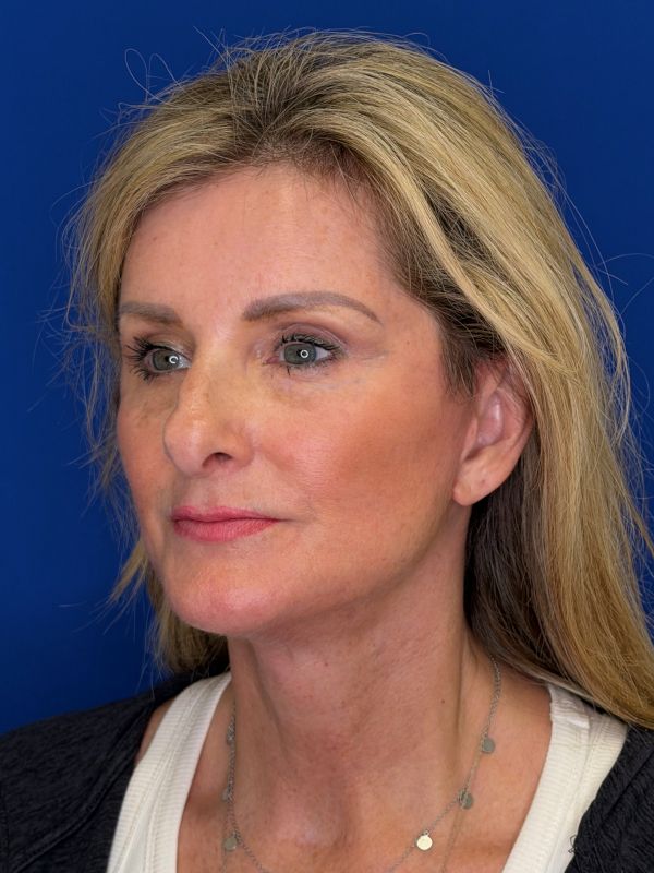 Facelift Before & After Image