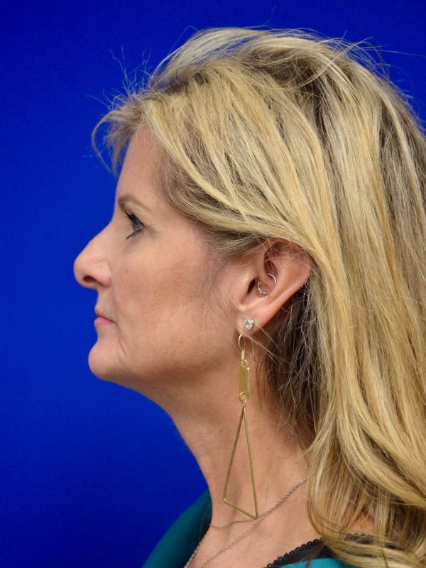 Facelift Before & After Image