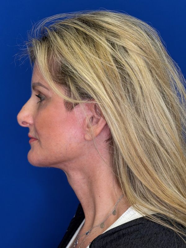 Facelift Before & After Image