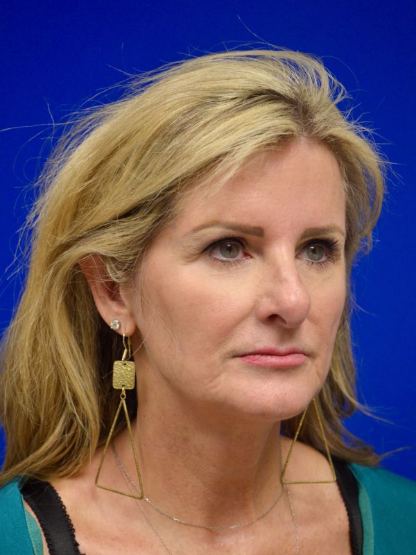 Facelift Before & After Image