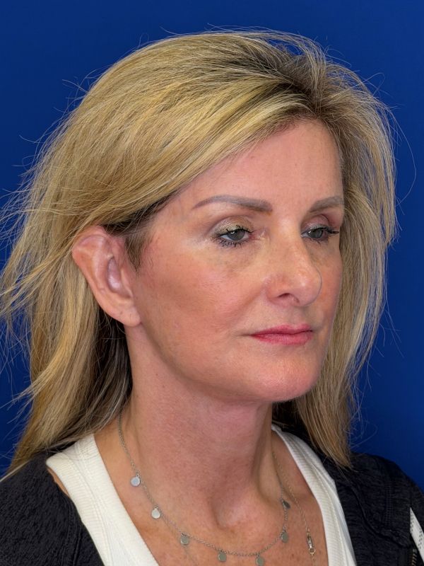 Facelift Before & After Image