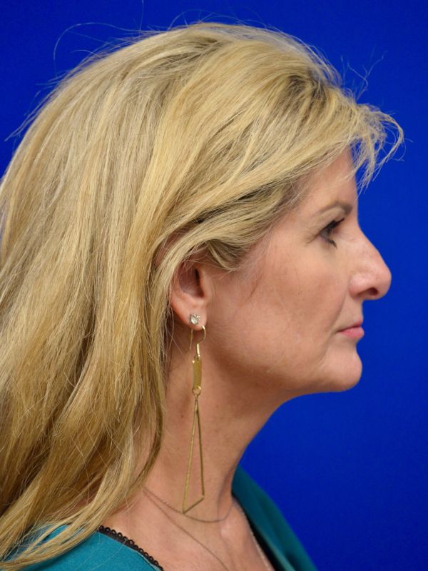 Facelift Before & After Image