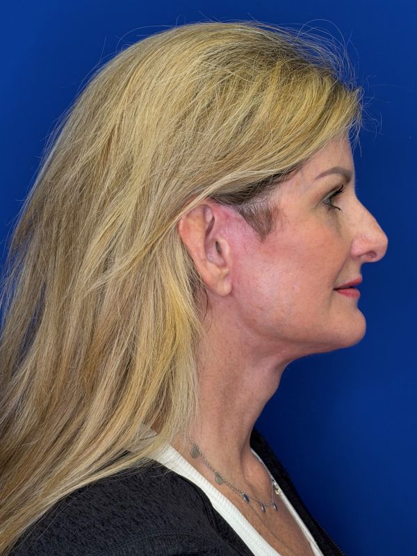 Facelift Before & After Image