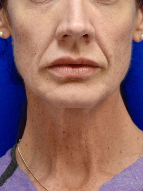 Facelift Before & After Image