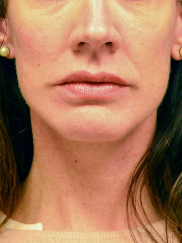 Facelift Before & After Image