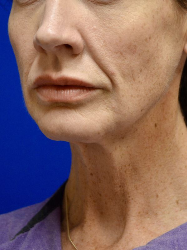 Facelift Before & After Image