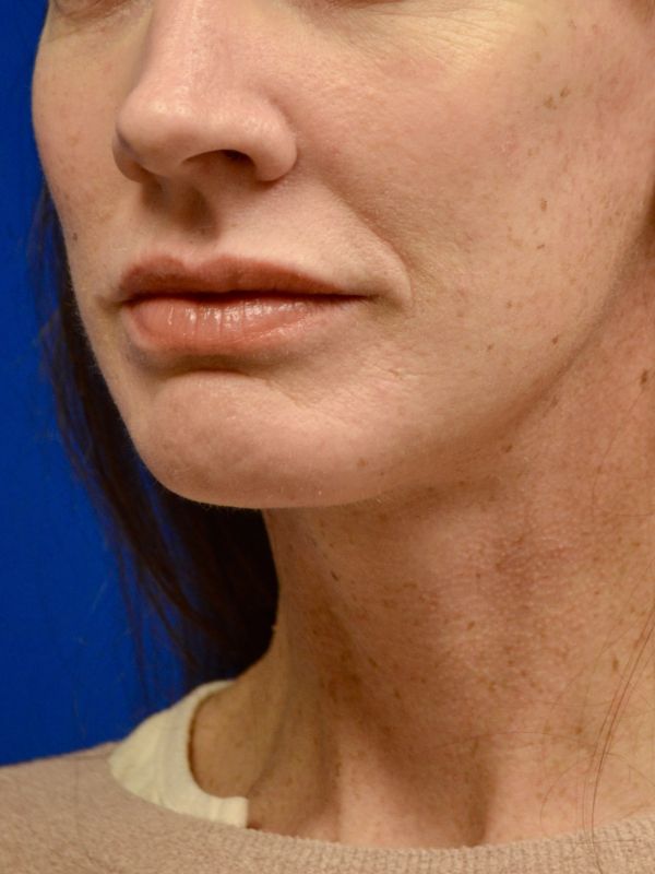 Facelift Before & After Image