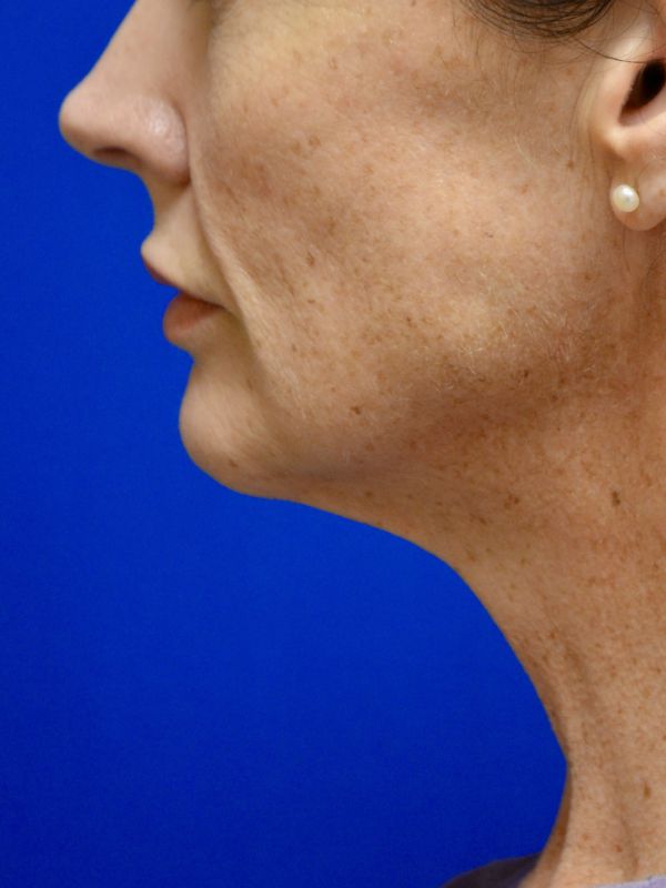 Facelift Before & After Image