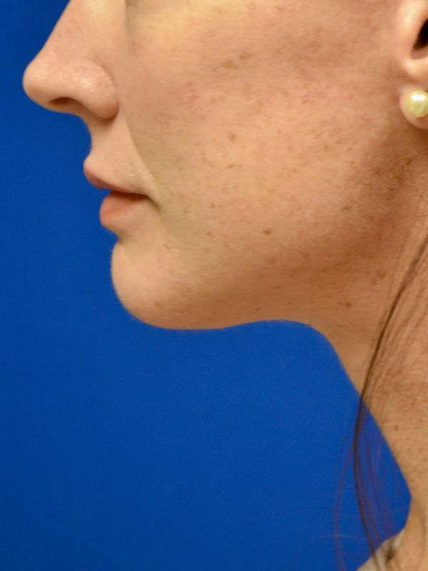 Facelift Before & After Image