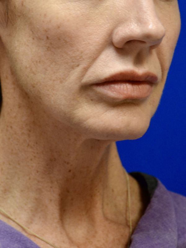 Facelift Before & After Image