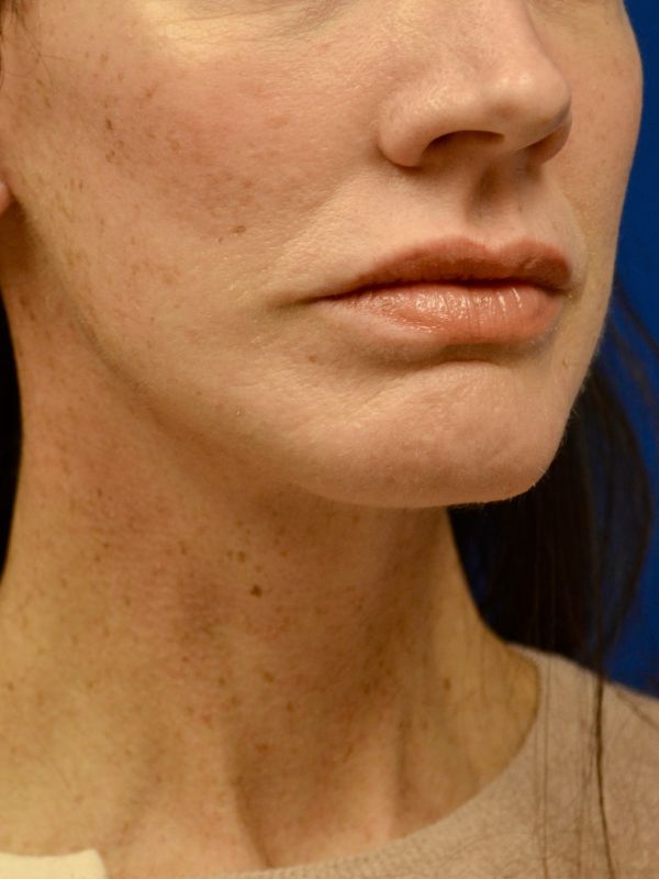 Facelift Before & After Image