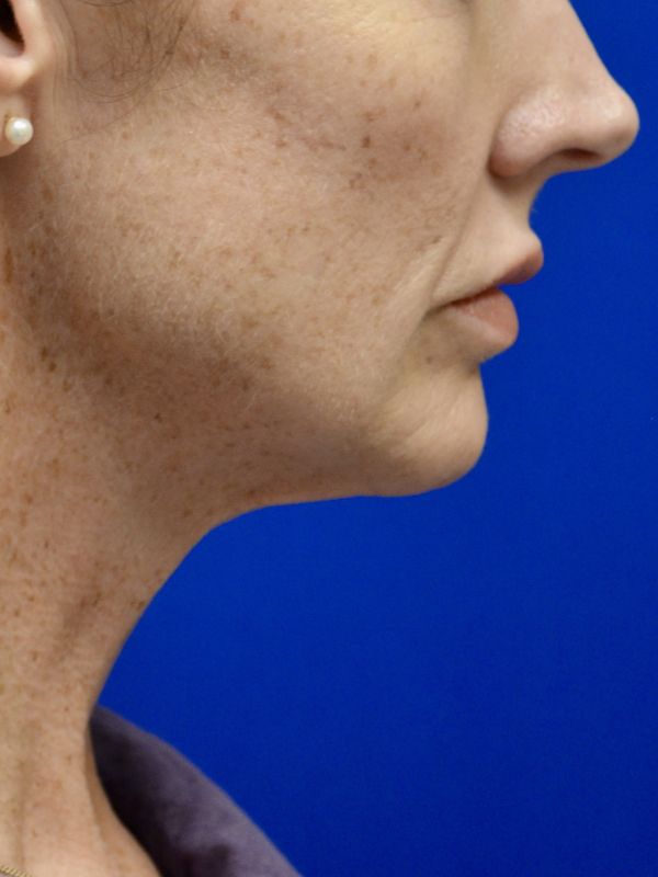 Facelift Before & After Image