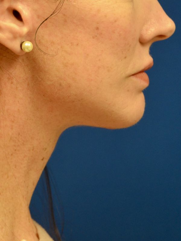 Facelift Before & After Image