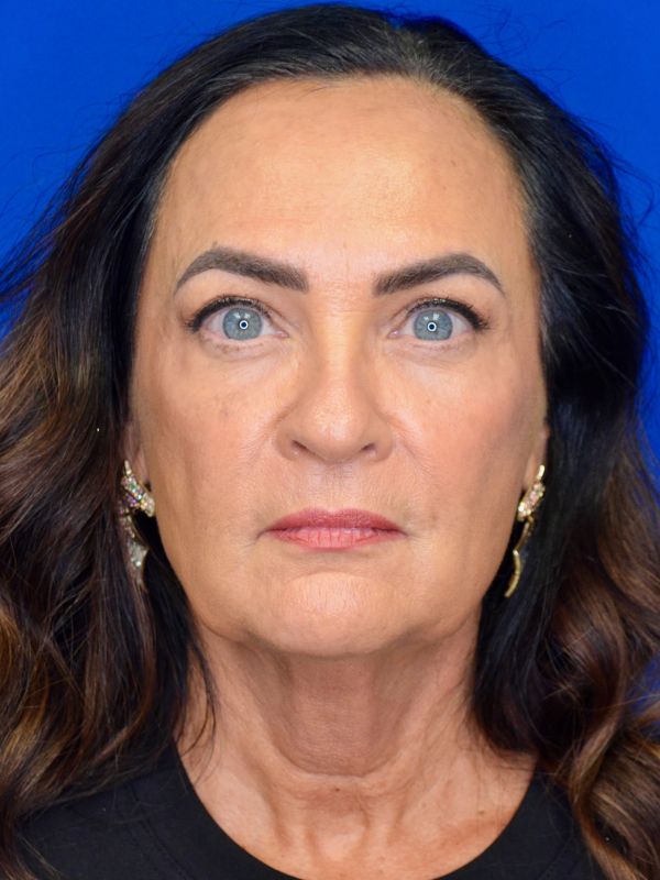 Facelift Before & After Image