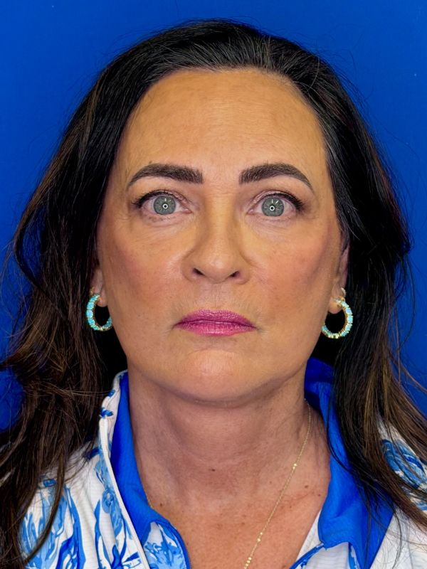 Facelift Before & After Image