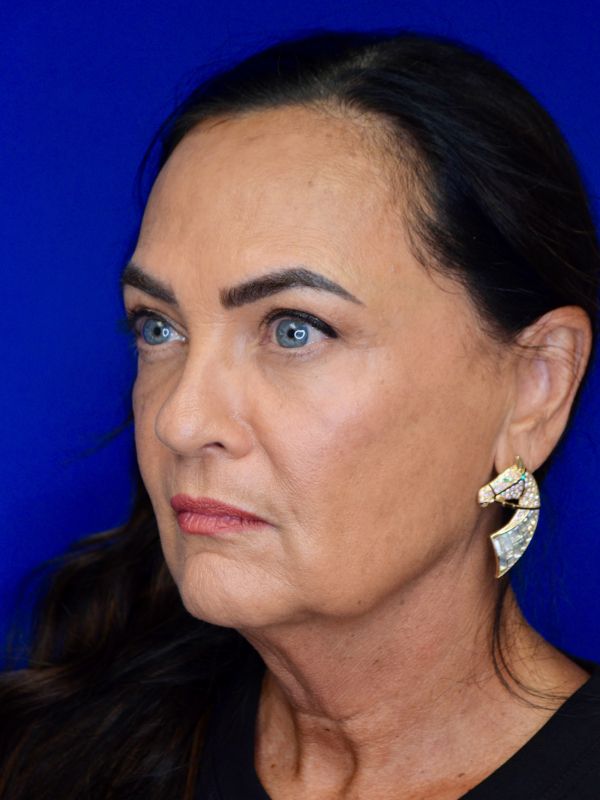 Facelift Before & After Image