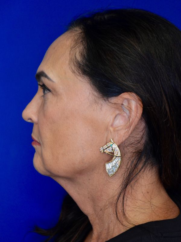 Facelift Before & After Image