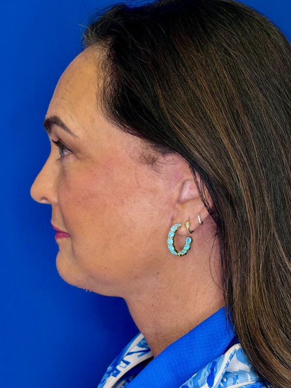 Facelift Before & After Image