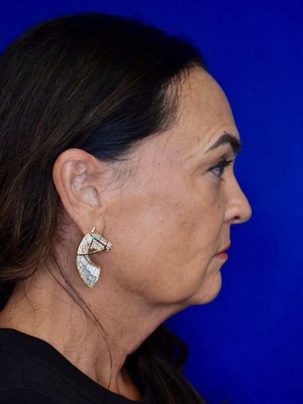 Facelift Before & After Image