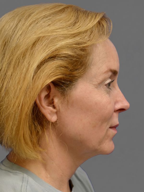 Facelift Before & After Image