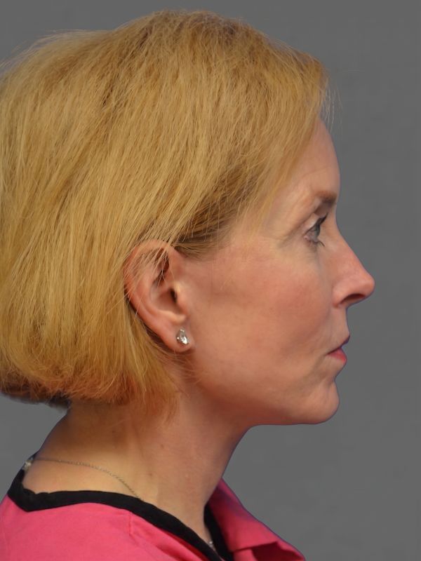 Facelift Before & After Image