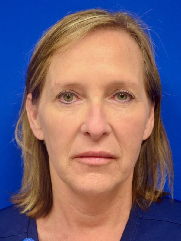 Facelift Before & After Image