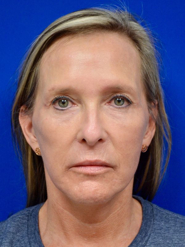 Facelift Before & After Image