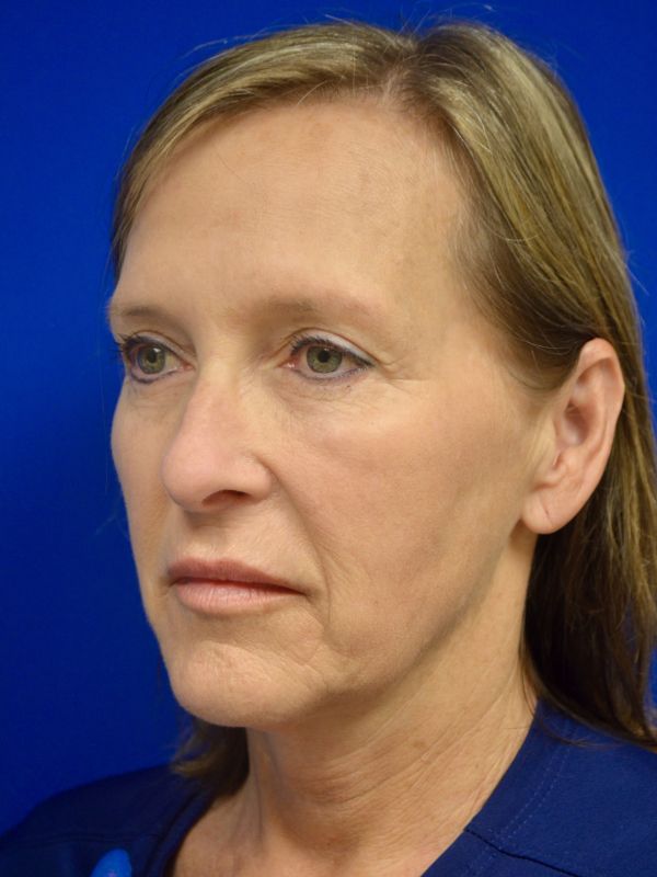 Facelift Before & After Image