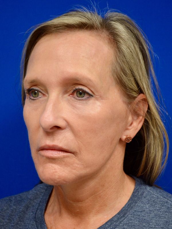 Facelift Before & After Image