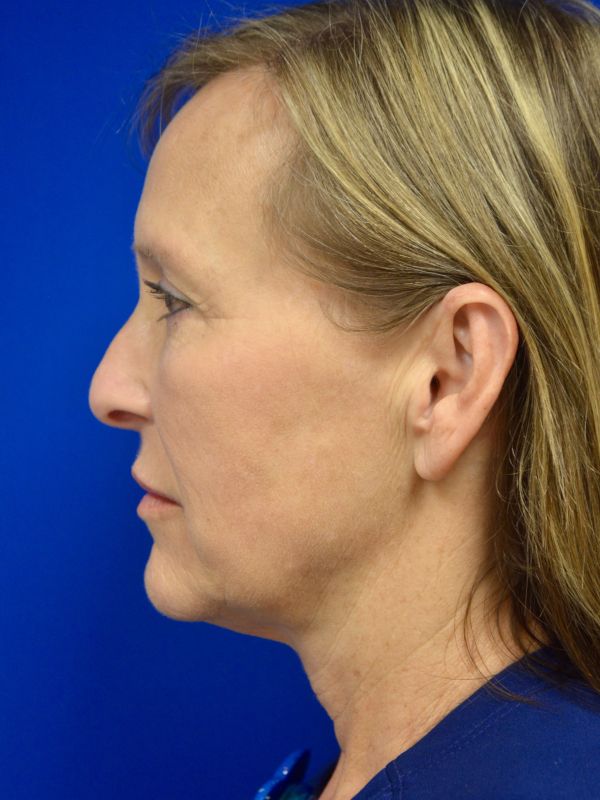 Facelift Before & After Image