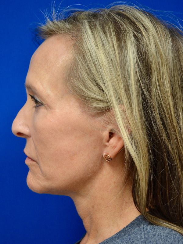 Facelift Before & After Image