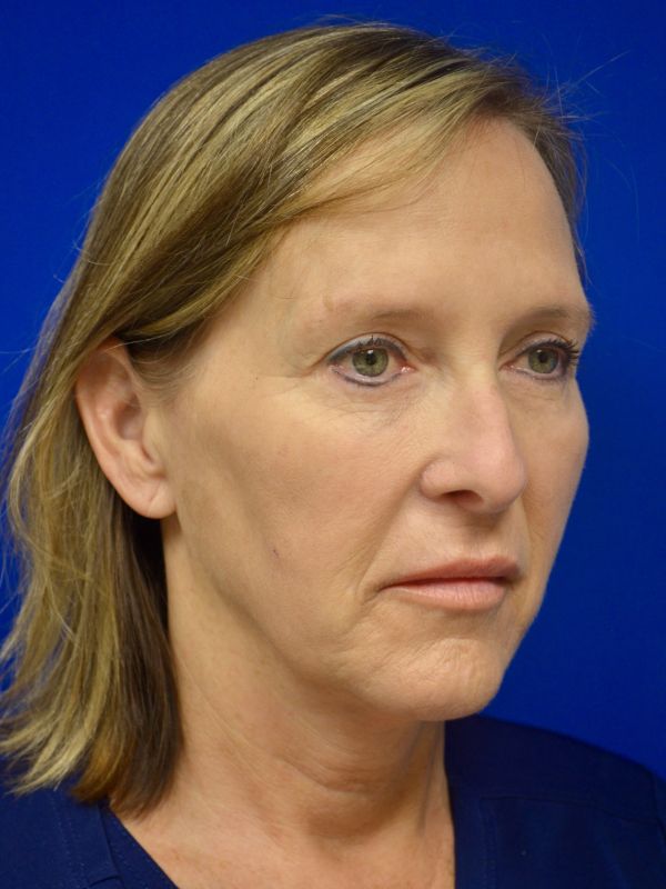Facelift Before & After Image