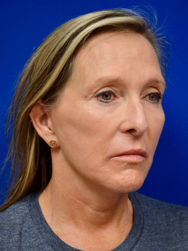 Facelift Before & After Image