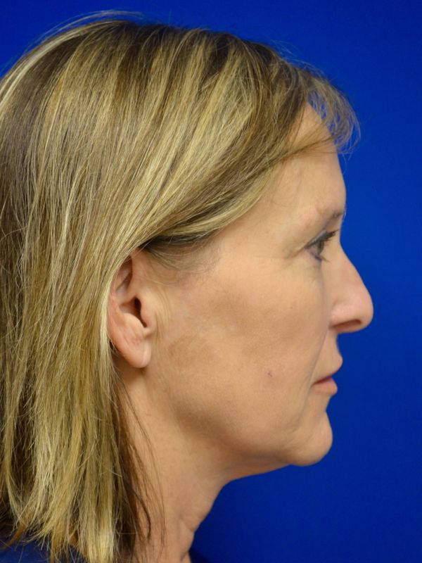 Facelift Before & After Image