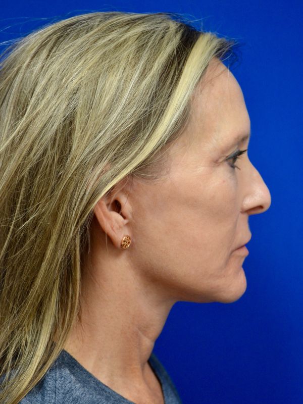Facelift Before & After Image