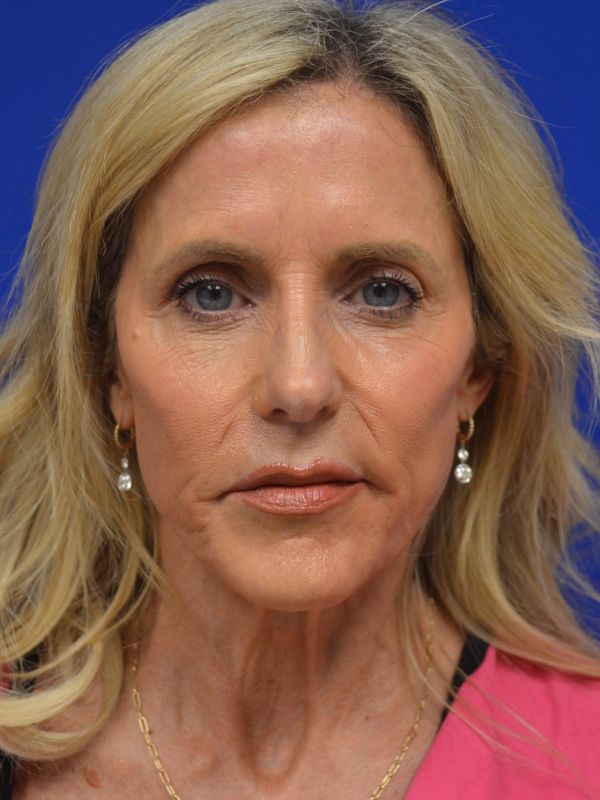 Facelift Before & After Image