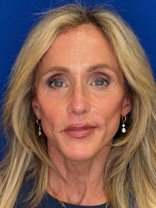 Facelift Before & After Image