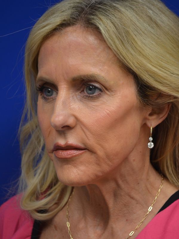 Facelift Before & After Image