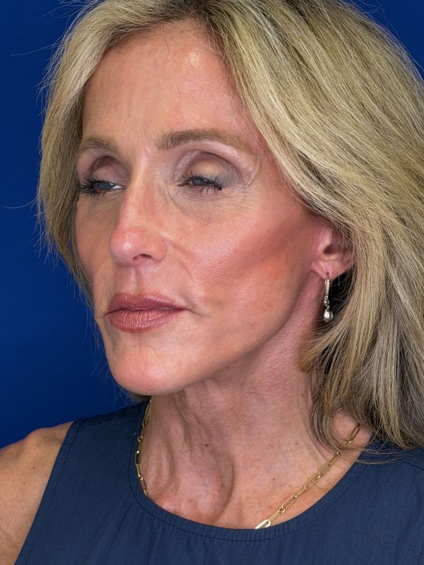 Facelift Before & After Image