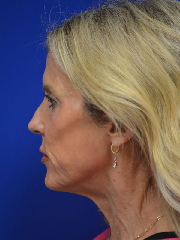 Facelift Before & After Image