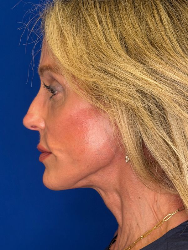 Facelift Before & After Image