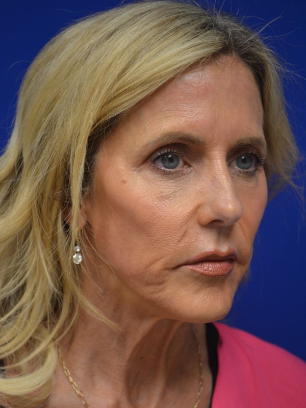 Facelift Before & After Image