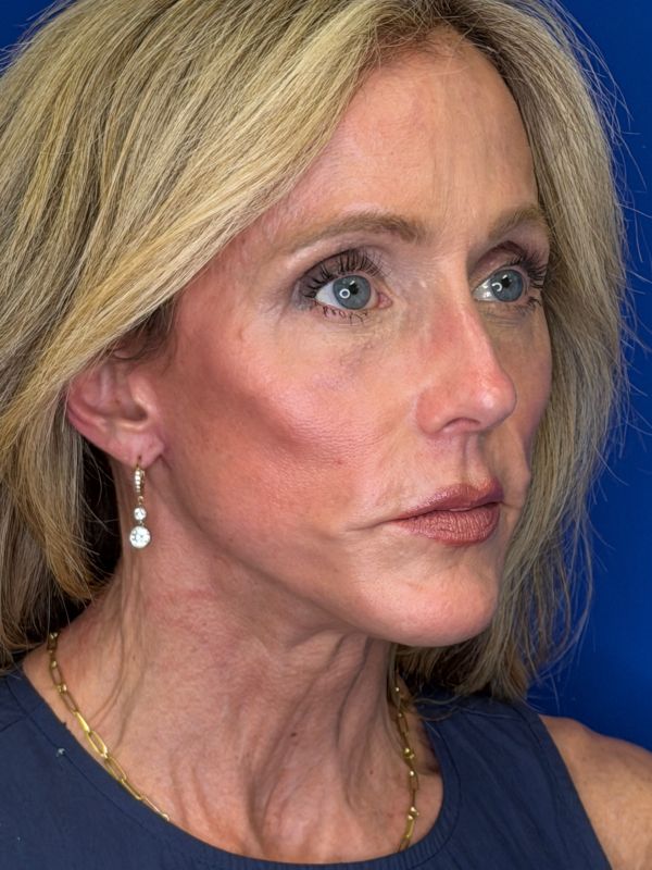 Facelift Before & After Image