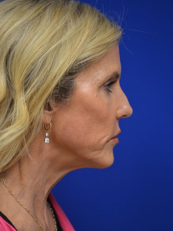 Facelift Before & After Image